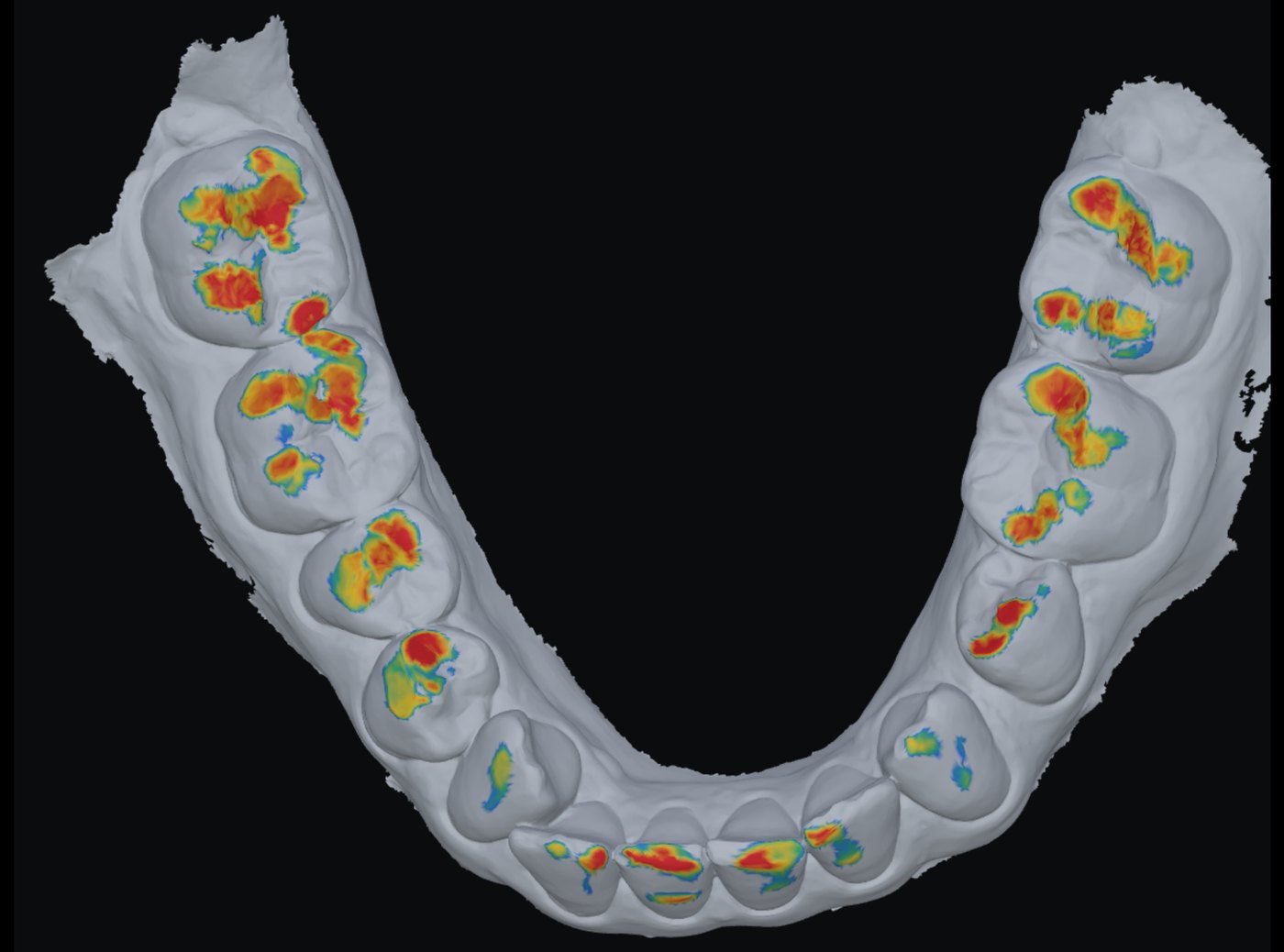 Lower jaw with the occlusal contacts coloured from red (touching) to blue (0.3 mm apart)
