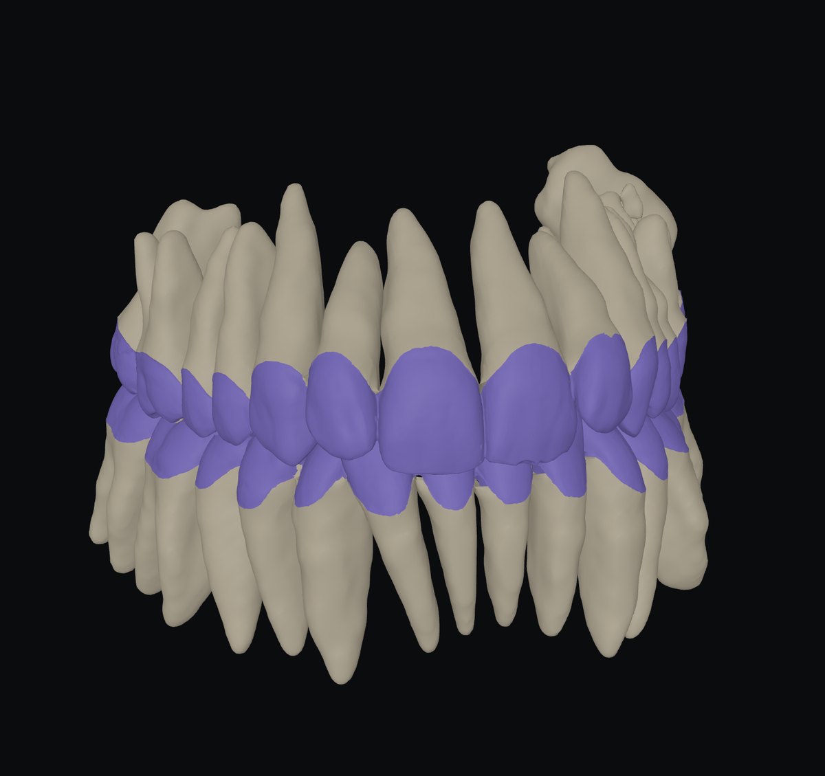 Teeth assembled from two sources: crowns from the scan, roots from the CT
